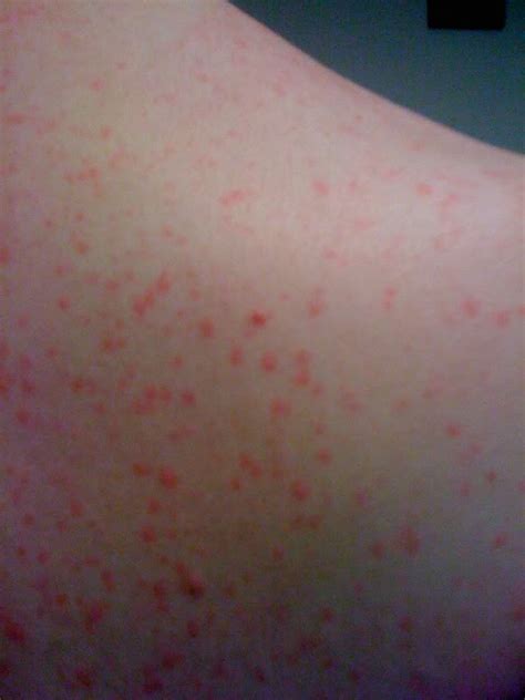 Cholinergic Urticaria Pictures Photographs And Images Of Cholinergic