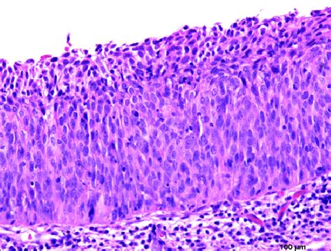 Cervical Squamous Intraepithelial Lesion Hot Sex Picture