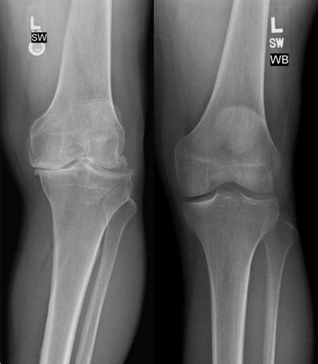 Knee Arthritis X Rays After Stem Cell Therapy Stem Cell Medical