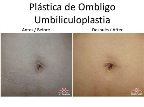 Umbilicoplastía Cirugía Plástica Del Ombligo Operación De Ombligo