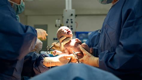 Rate Of Caesarean Sections And Inductions Increasing For First Time