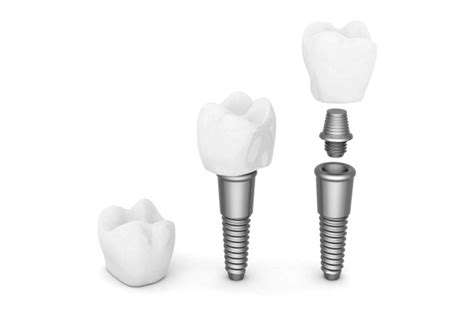 The 3 Parts Of Dental Implant Tooth Replacement Frankford Dental Care