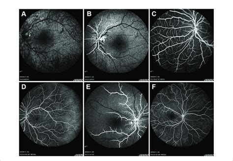 Baseline Fundus Fluorescein Angiography Ffa Left Eye Angiogram