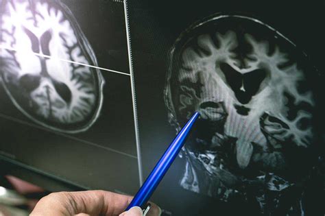 How Drug Addiction Affects The Brain Banyan Treatment Centers