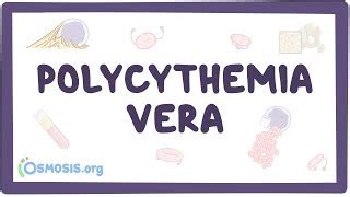 Polycythemia Vera Causes Symptoms Diagnosis Treatment Doovi