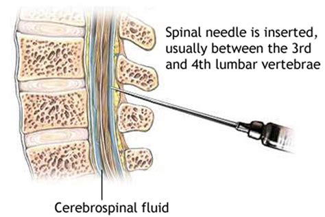 Lumbar Puncture Procedure Position And Lumbar Puncture