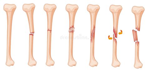 Structurally, bones are somewhat elastic because they are primarily made up of collagen. Diagram Of Leg Fracture In Different Stages Stock Vector ...