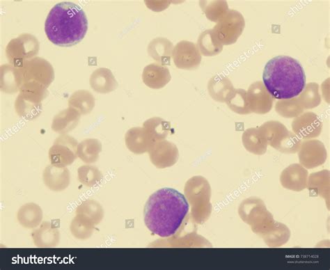 Acute Lymphoblastic Leukemia All L2 Subtype Stock Photo 738714028