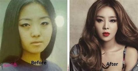 Which K Pop Idols Had Their Plastic Surgery Done Openly