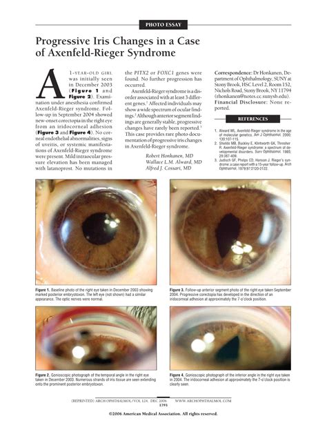 Progressive Iris Changes In A Case Of Axenfeld Rieger Syndrome