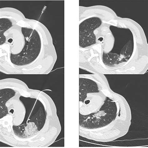 Ct Guided Transthoracic Needle Biopsy From A Lesion In Left Lungs Upper