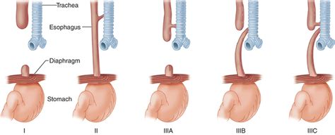 Esophageal Atresia And Or Tracheoesophageal Fistula Obgyn Key The