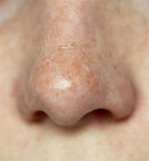 Dry Skin On Side Of Nose