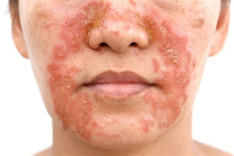 Psoriasis What It Looks Like And How To Treat It Ws Dermatology