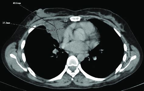 Computed Tomography Thorax Showing Anterior Mediastinal Mass Download