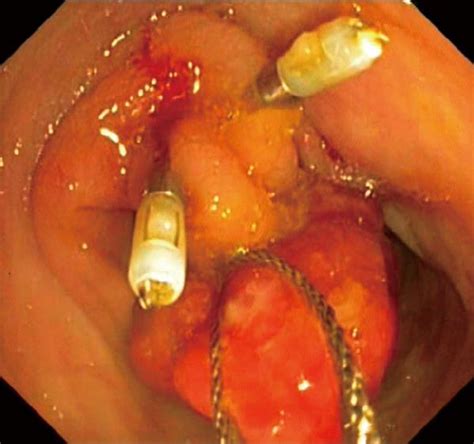 Maybe you would like to learn more about one of these? Endoscopic treatment of a large colonic polyp as a cause ...