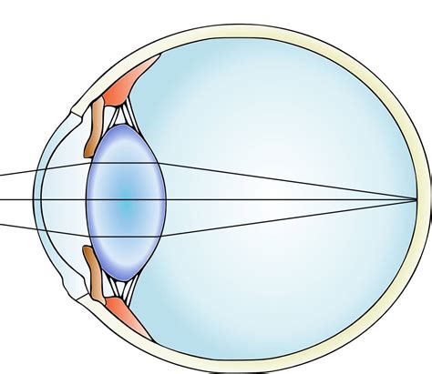Chirurgie de la cataracte - Dr Patrick Loriaut - Chirurgien Ophtalmologiste