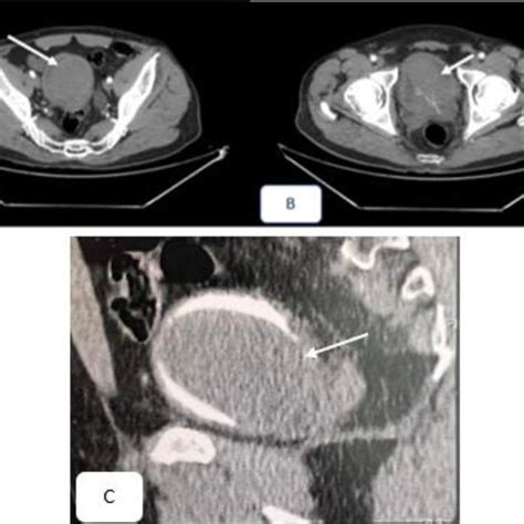 A And B Contrast Enhanced Ct Scan Axial Section Showing A