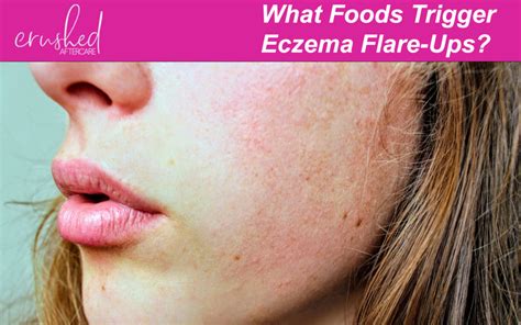 Eczema Flare Ups Foods And Healing Balms Crushed Vegan Aftercare