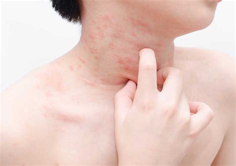 Can Food Intolerance Cause Rashes