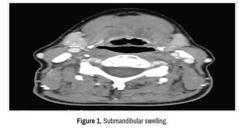 Clinical Case Submandibular Swelling