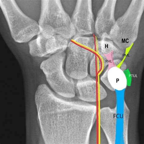 35 Year Old Male With Pisiform Dislocation In The Left Wrist Findings