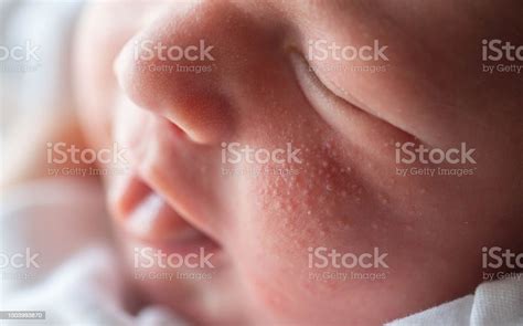 Pimples On The Face Of A Newborn Babys Adaptation To The Environment