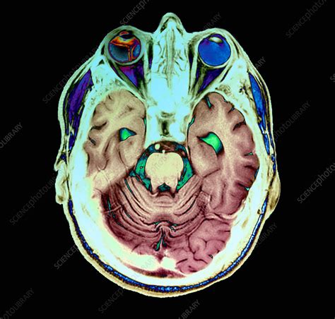 Retinal Detachment Mri Scan Stock Image C0551837 Science Photo