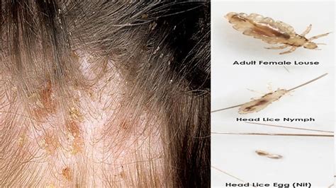 Howto How To Get Rid Of Lice Eggs In Hair Fast At Home