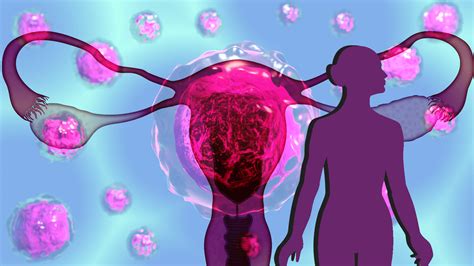Five Markers Identified For Diagnosing Ovarian Cancer