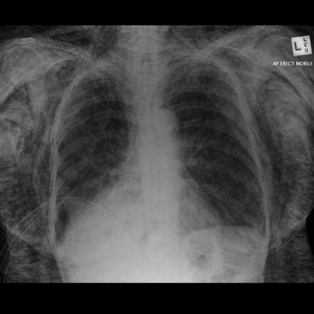 Surgical Emphysema X Ray Sexiz Pix Vrogue Co