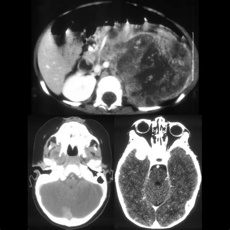 Infant With A Right Orbital Mass Pediatric Radiology Case Pediatric