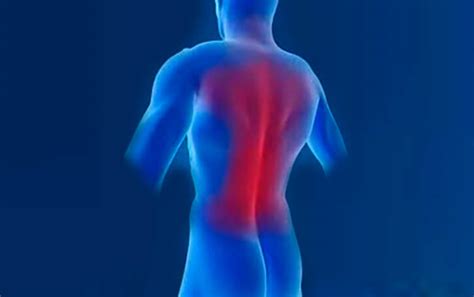 What Is Back Strain? - Premia Spine