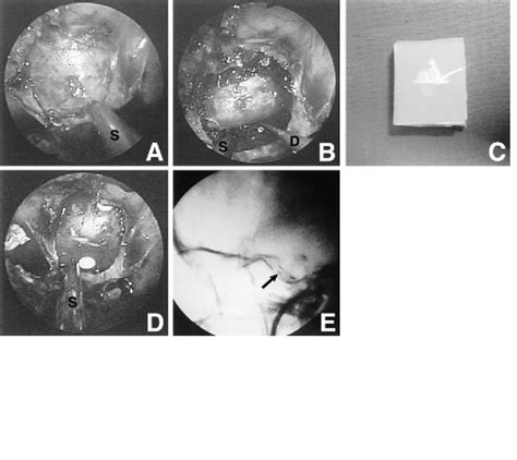 Case 1 Intraoperative Endoscopic Views Showing A The Sellar Floor