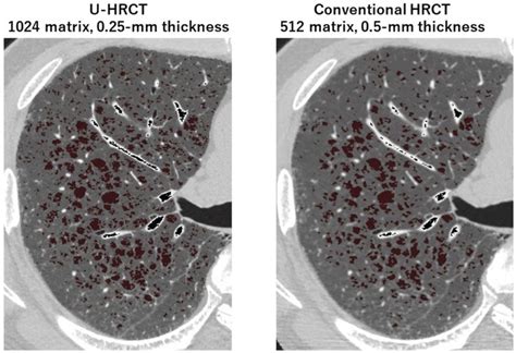 Ultra High Resolution Ct U Hrct Image Compared With A Conventional