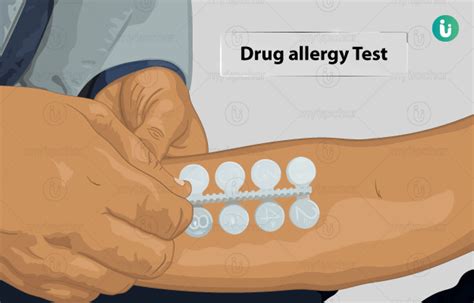 Drug Allergy Test Procedure Purpose Results Cost Price