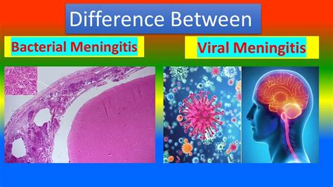 Difference Between Bacterial Meningitis And Viral Meningitis Youtube