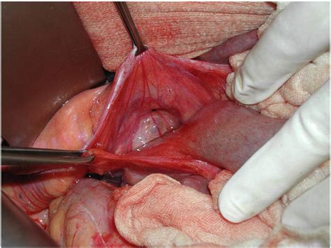 References In Right Side Paraduodenal Hernia Unexplained Recurrent