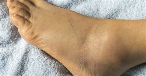 Swelling Feet Remedies Foot Remedies Swollen Ankles Ankle Swelling