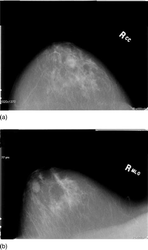 Mammograms Showing A Cranial Caudal Cc View And B Mlo View For