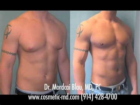On Gynecomastia Miami Florida Patients Are Adults And Adolescents