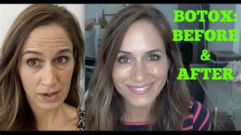 Botox Best Before And After Video Doovi