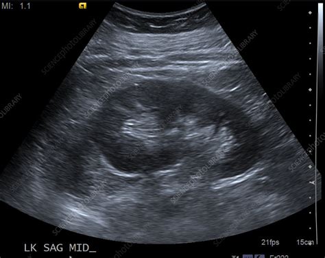 Normal Kidney Size Ultrasound