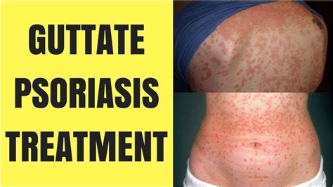 Home Remedies For Guttate Psoriasis Youtube