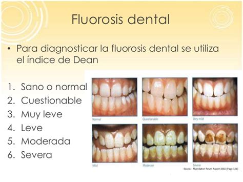 Fluorosisdental Clinic Dentists In Tijuana