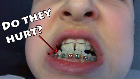 Barrier methods and spermicide begin working immediately. Do Braces Hurt: The Truth Revealed | The World Of Oral ...