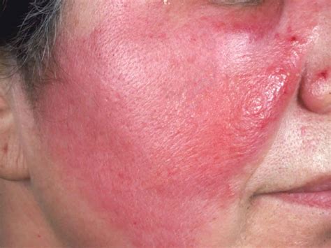 Cellulitis Causes Signs Symptoms Diagnosis Prevention