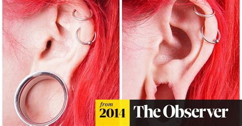 Big Increase In Surgery To Mend ‘flesh Tunnel Earlobes Cosmetic