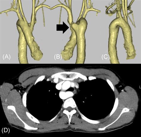 Preoperative Three‐dimensional Computed Tomography A Front View B