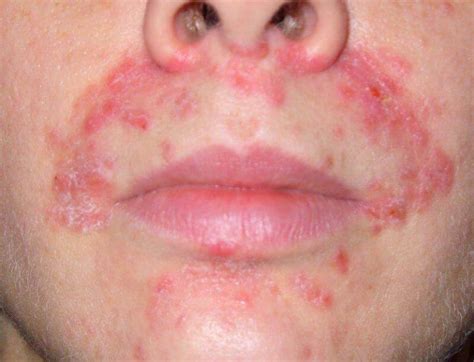 Perioral Dermatitis Pictures Symptoms And Pictures